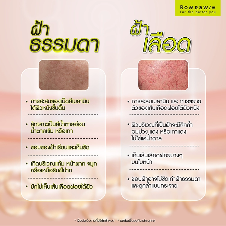 รักษาฝ้าเลือด