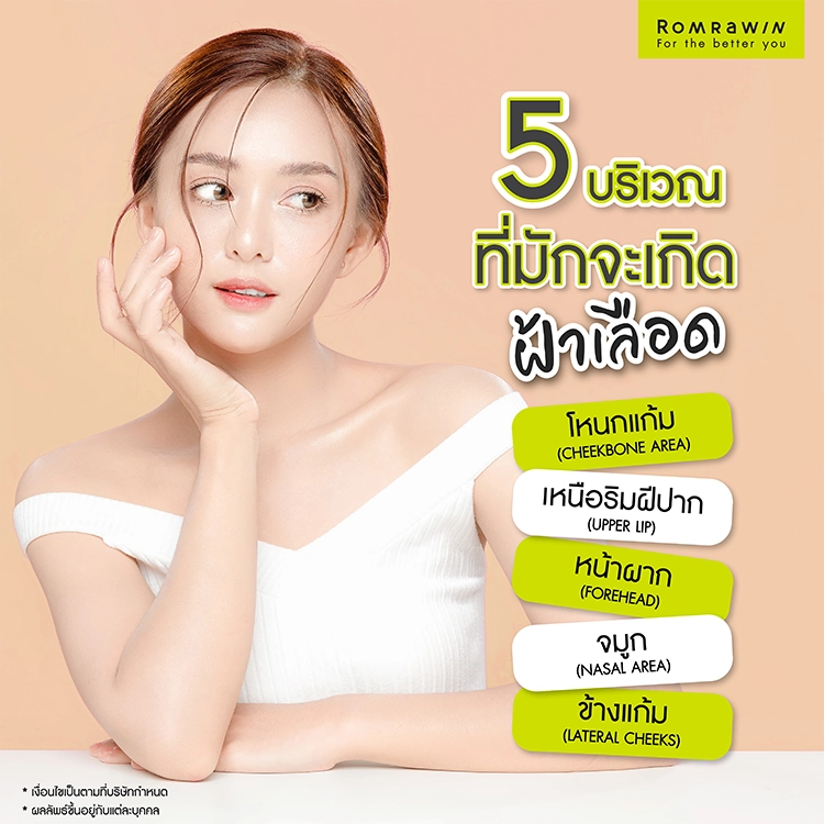 รักษาฝ้าเลือด