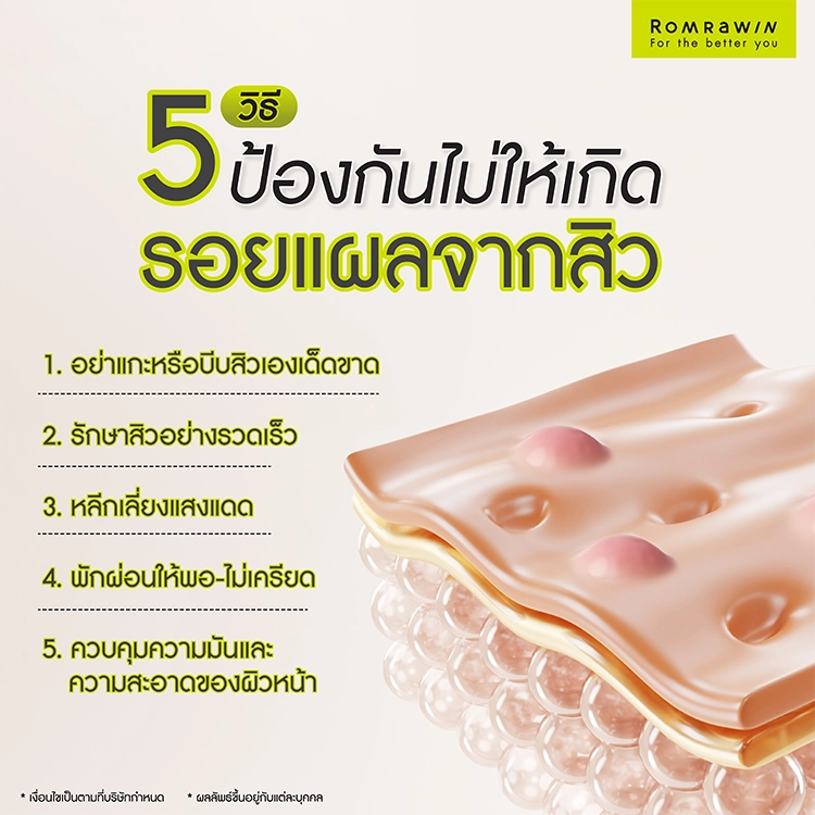 แผลเป็นจากสิว