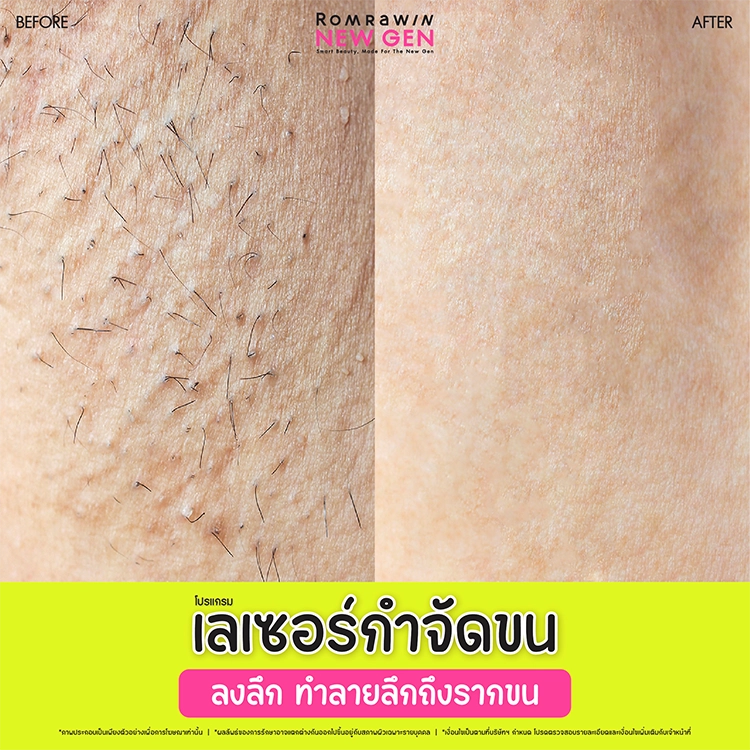 เลเซอร์รักแร้