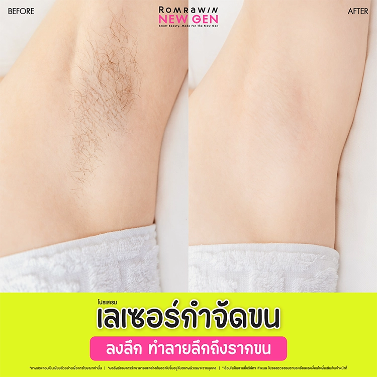 เลเซอร์รักแร้