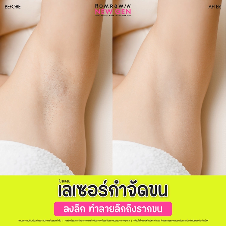 เลเซอร์รักแร้