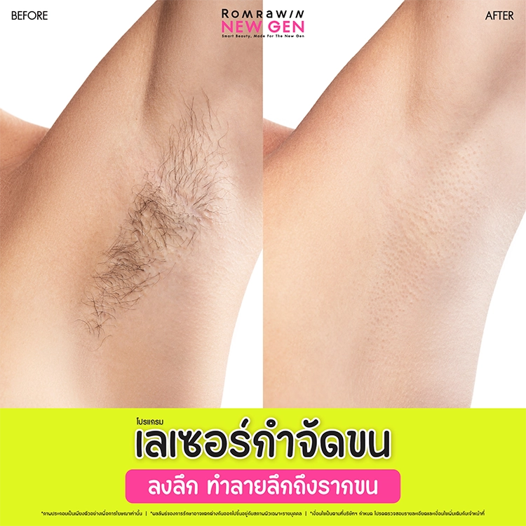 เลเซอร์รักแร้