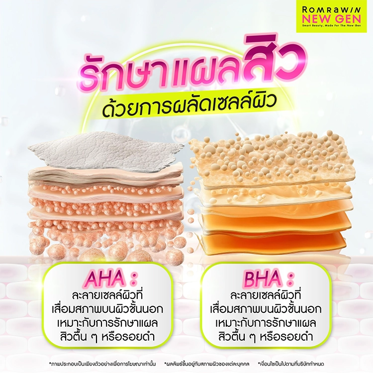 รักษาแผลสิว