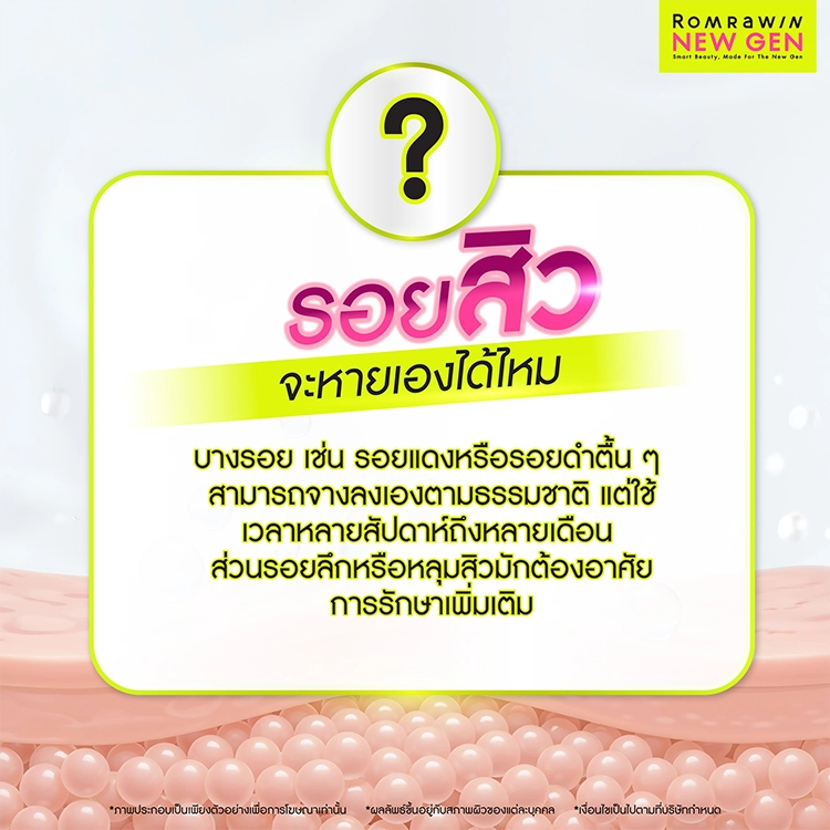 รักษาแผลสิว