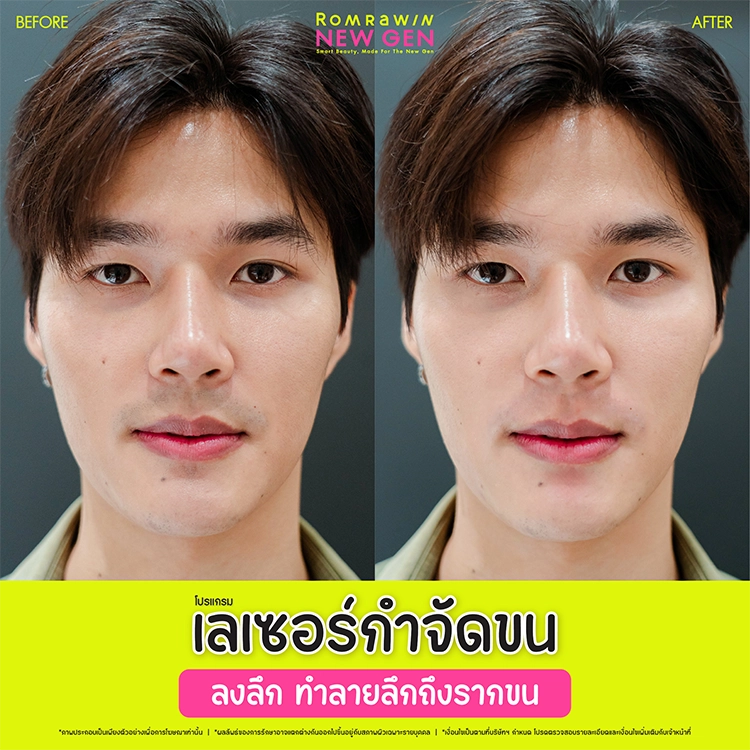 เลเซอร์ขนคุด