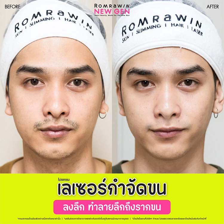 เลเซอร์ขนคุด