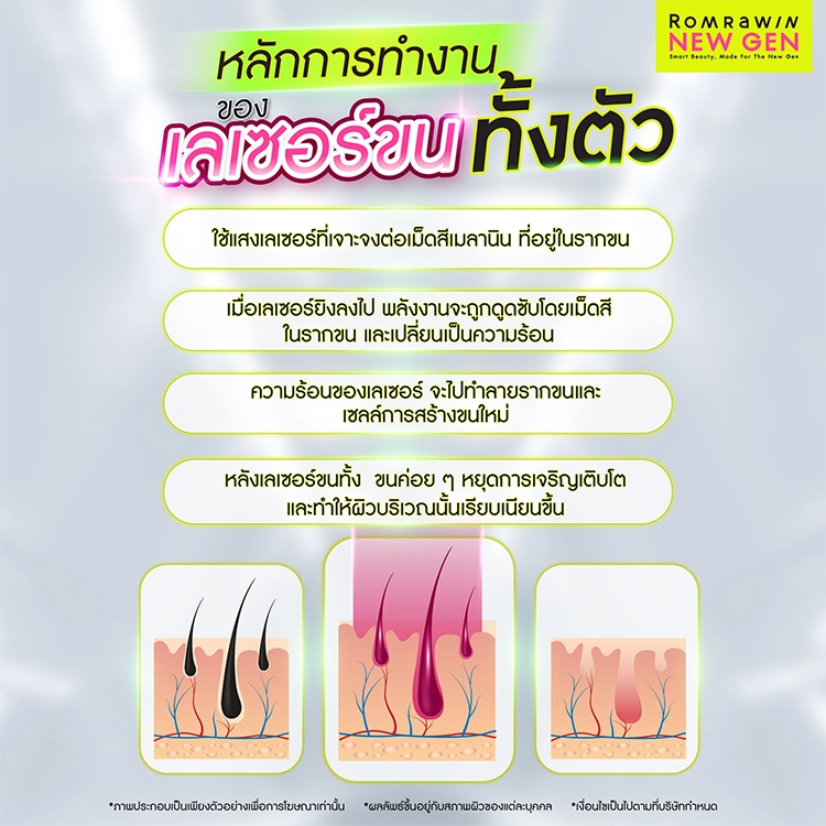 เลเซอร์ขนทั้งตัว