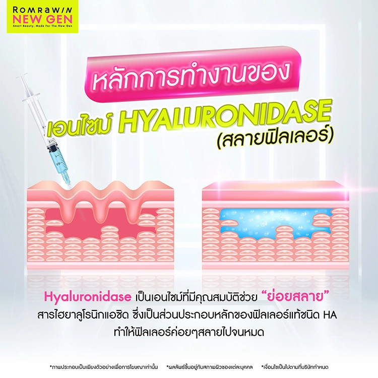 ฉีดสลายฟิลเลอร์