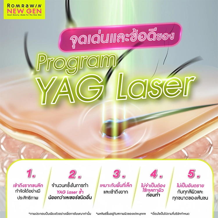 YAG Laser