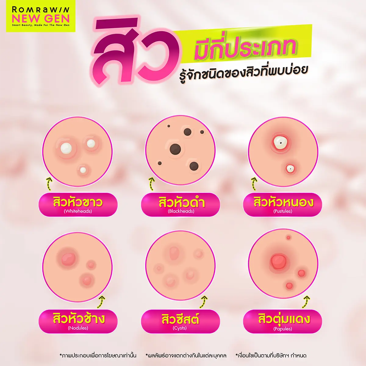 สิวมีกี่ประเภท