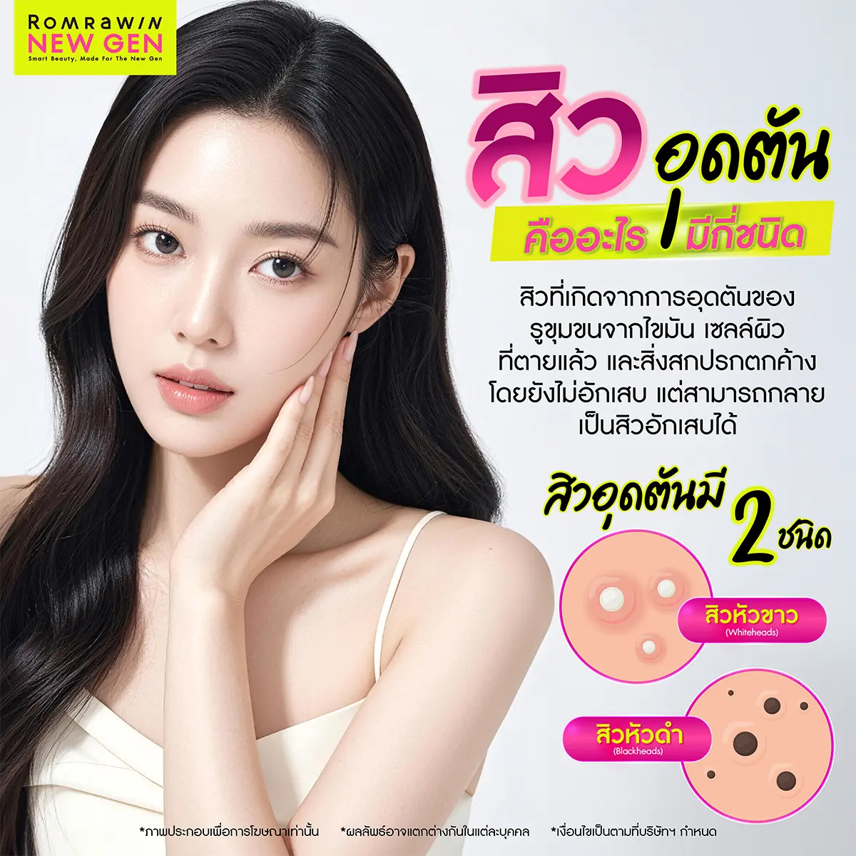 สิวมีกี่ประเภท