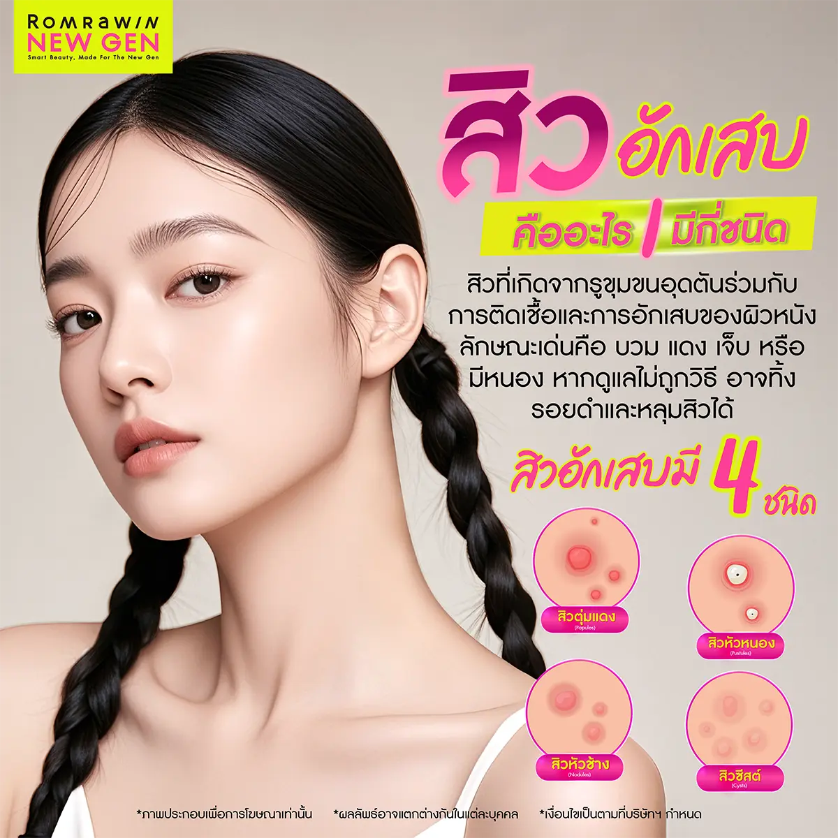 สิวมีกี่ประเภท