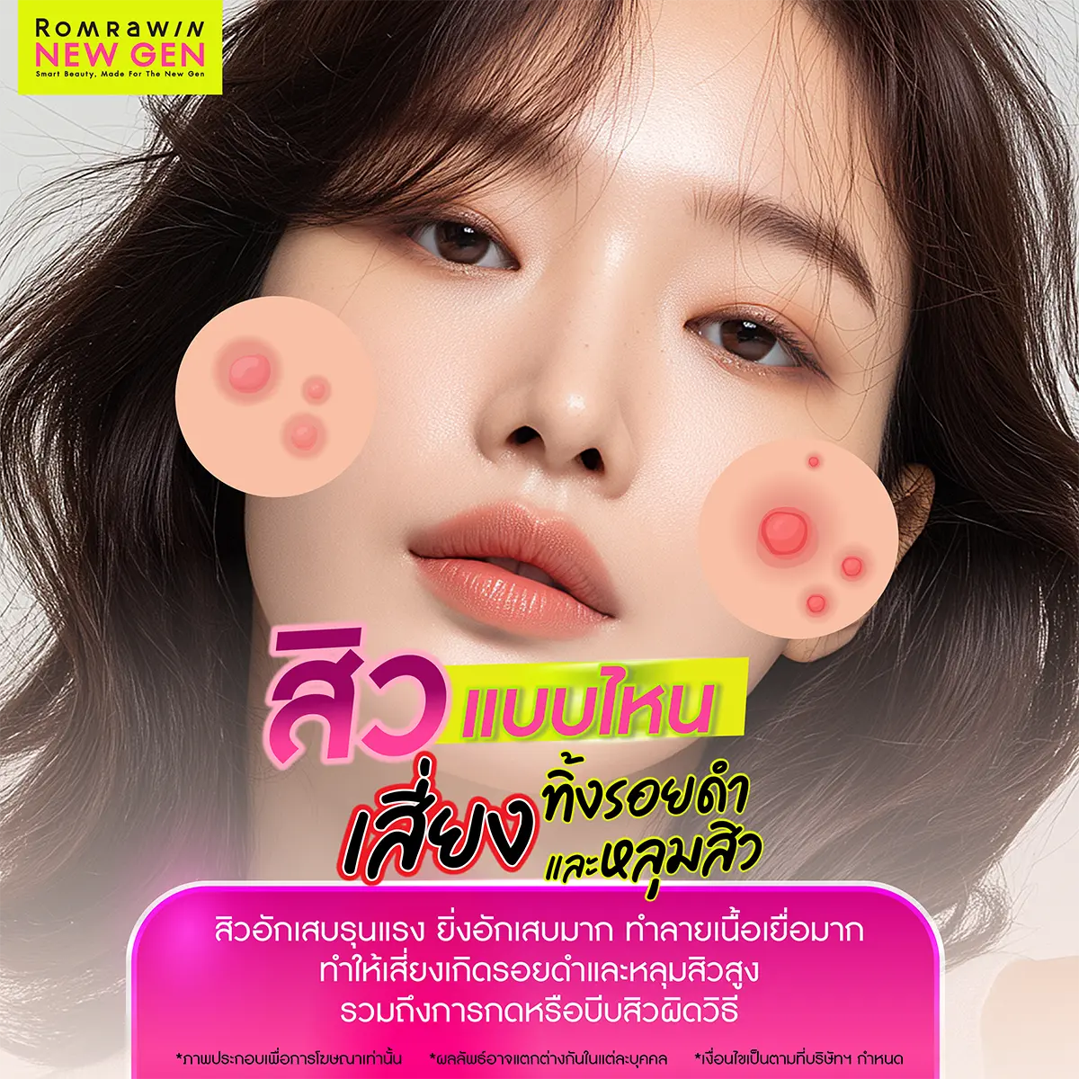 สิวมีกี่ประเภท