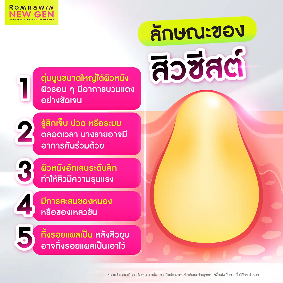 สิวซีสต์