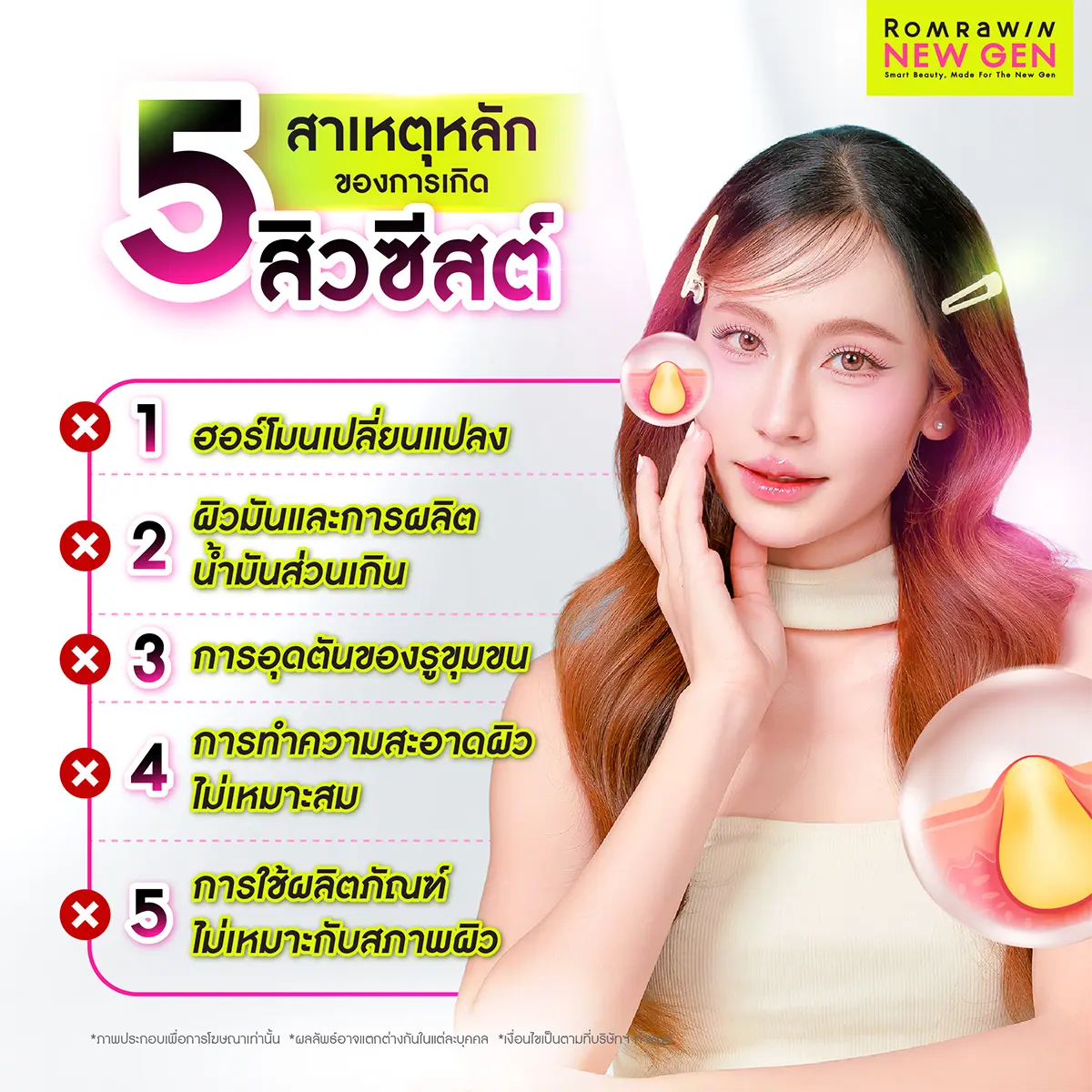 สิวซีสต์