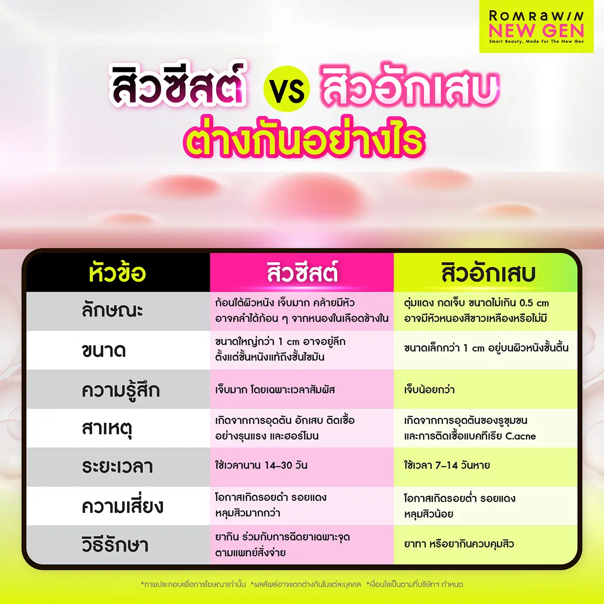สิวซีสต์