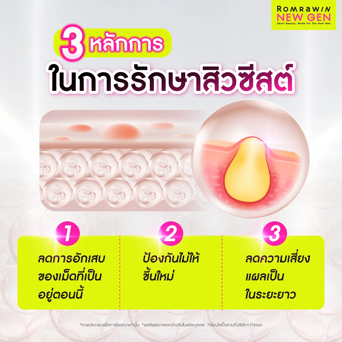 สิวซีสต์