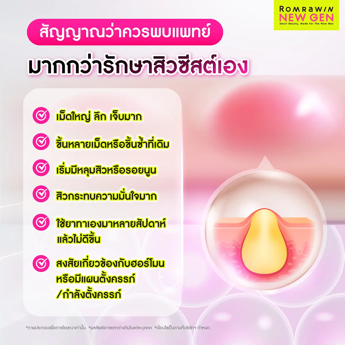 สิวซีสต์