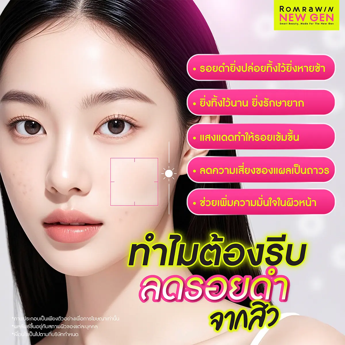 ลดรอยดำจากสิว