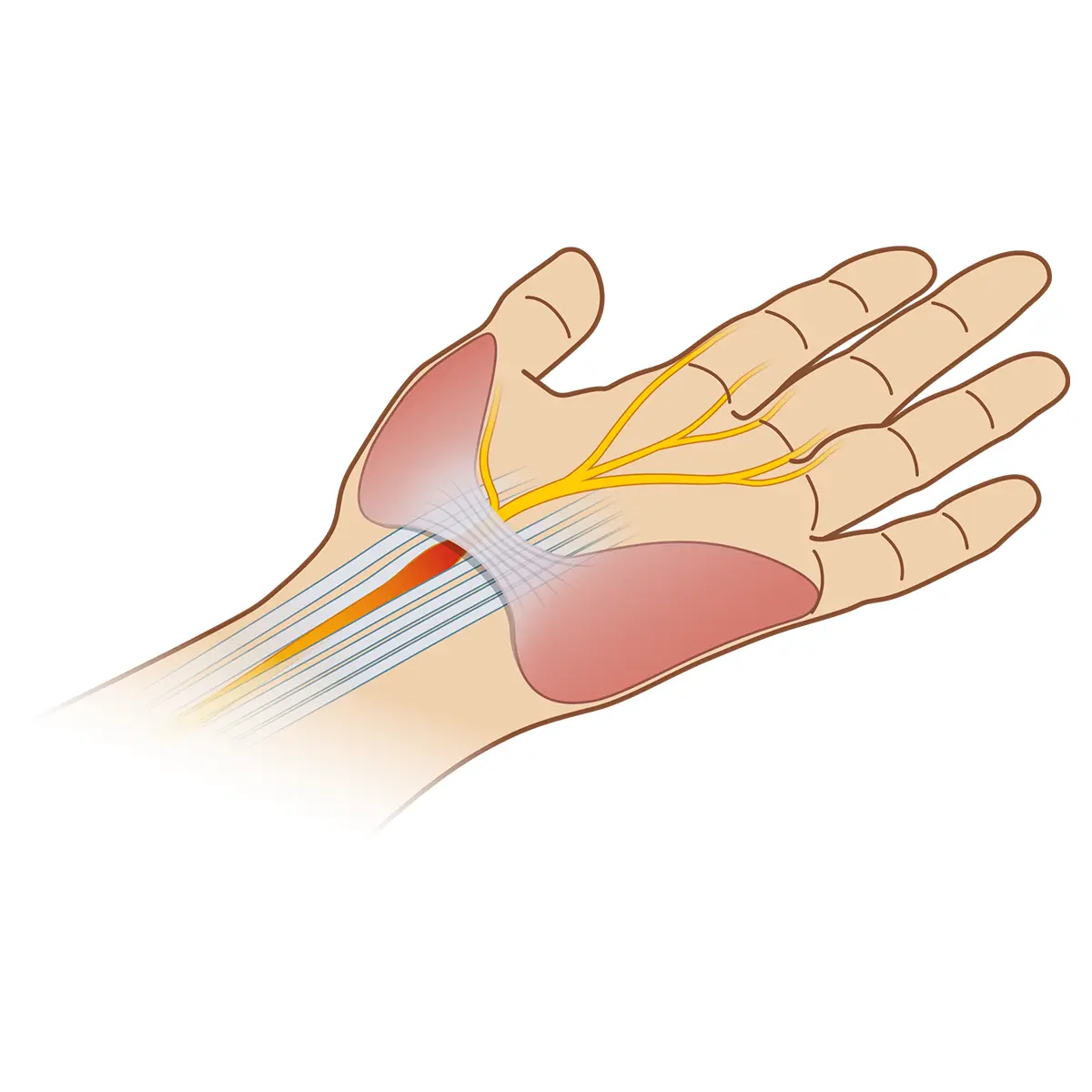พังผืดที่มือ