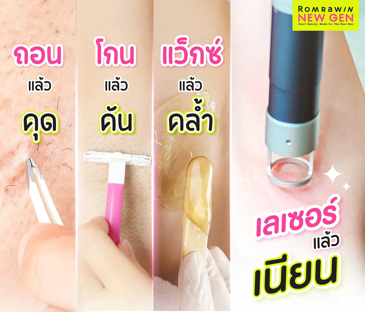 เลเซอร์ขน