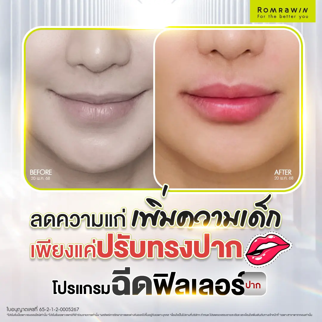 ฟิลเลอร์ปาก