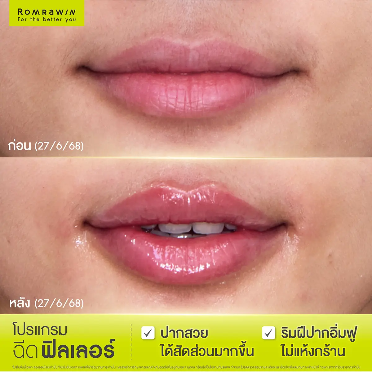 รีวิวฉีดฟิลเลอร์ปาก