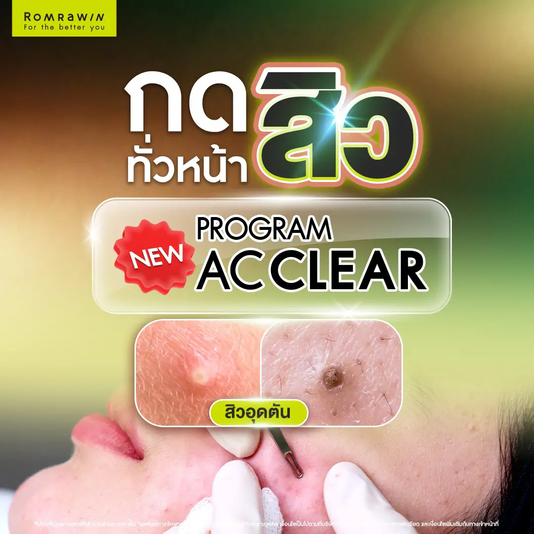 กดสิวใกล้ฉัน