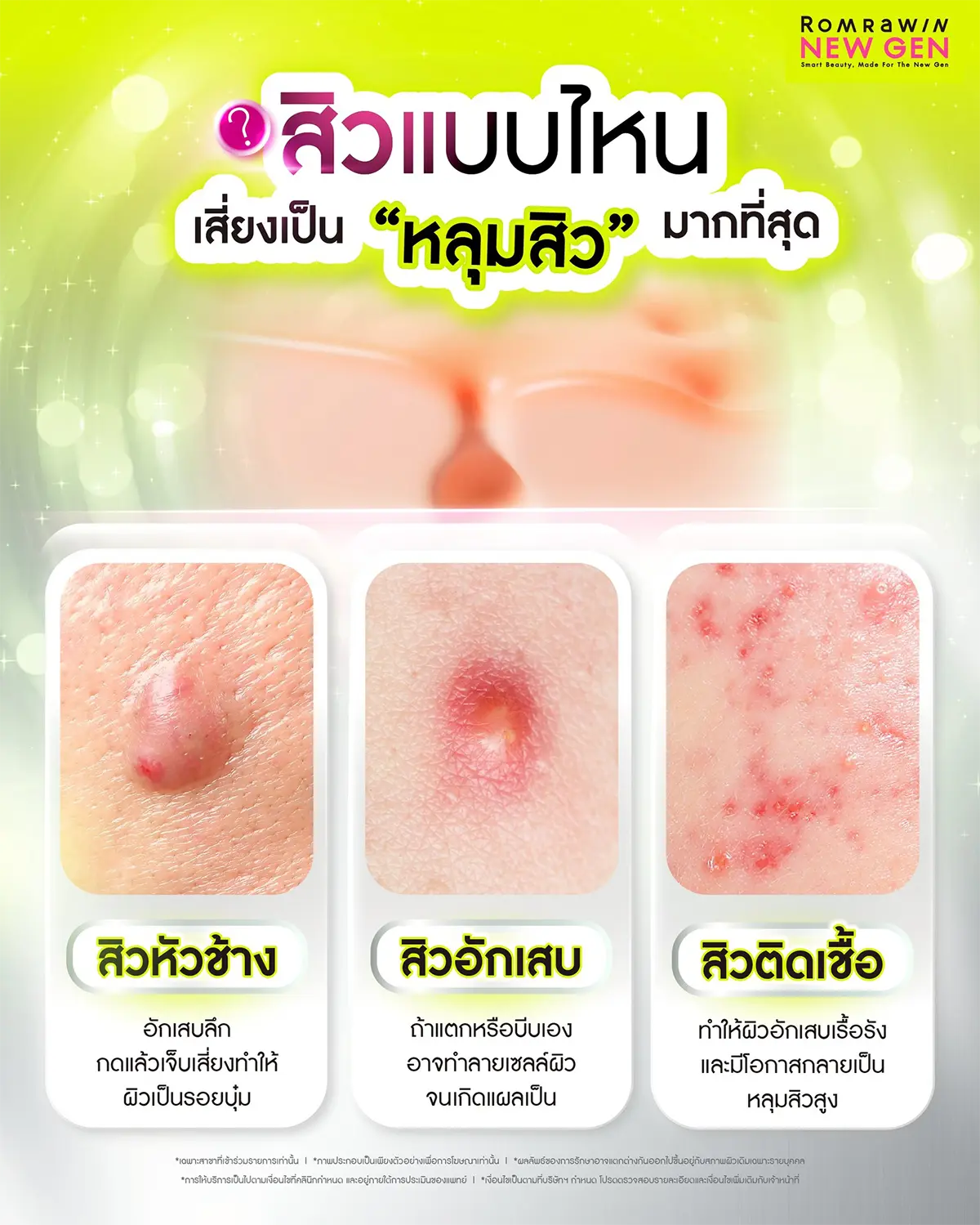 กดสิวใกล้ฉัน