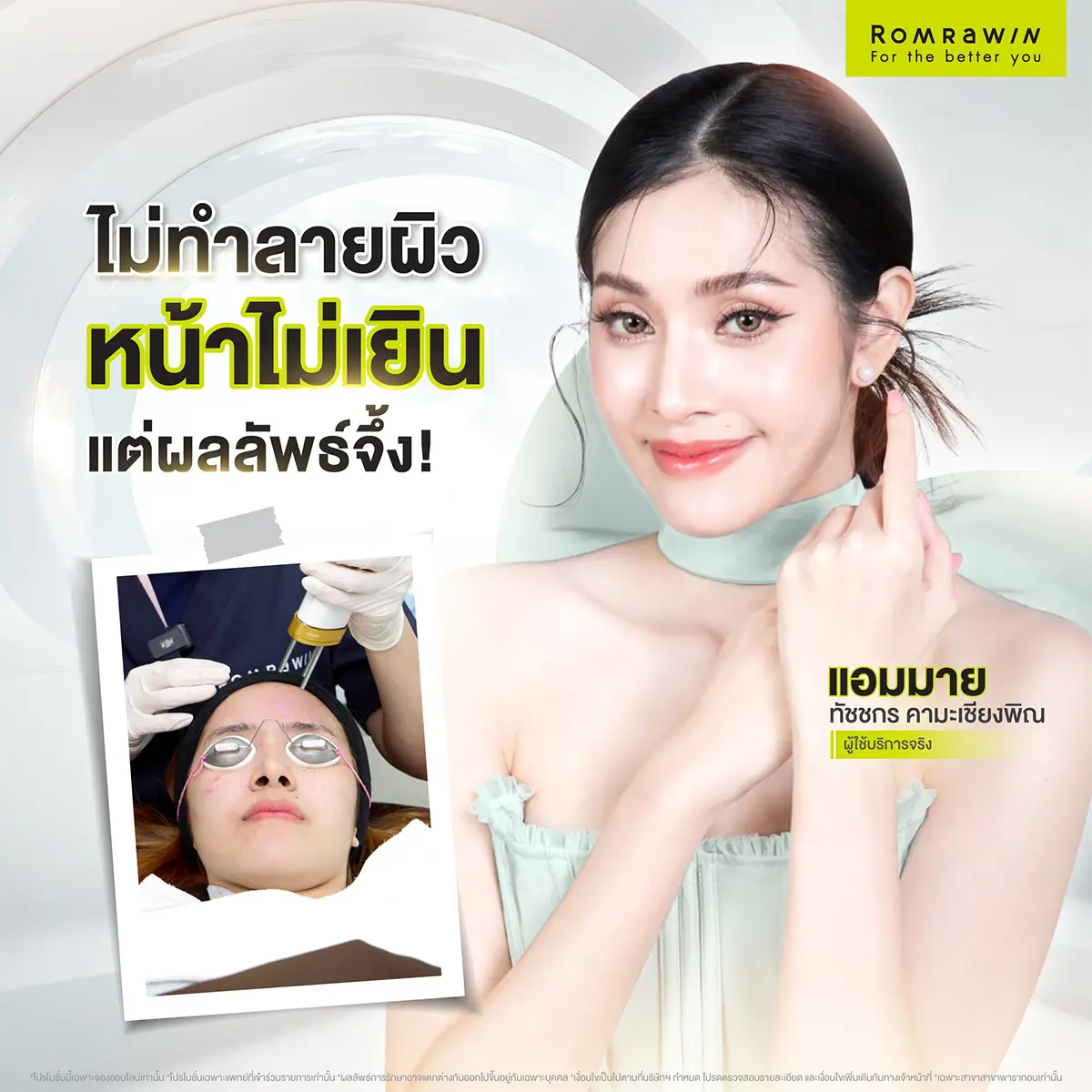 สิวฮอร์โมน