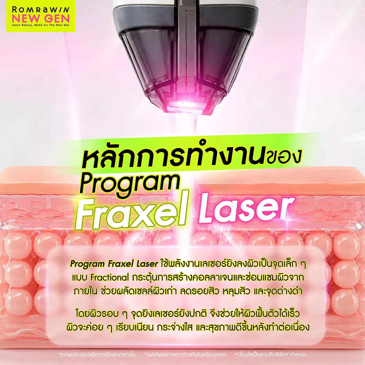 Fraxel Laser