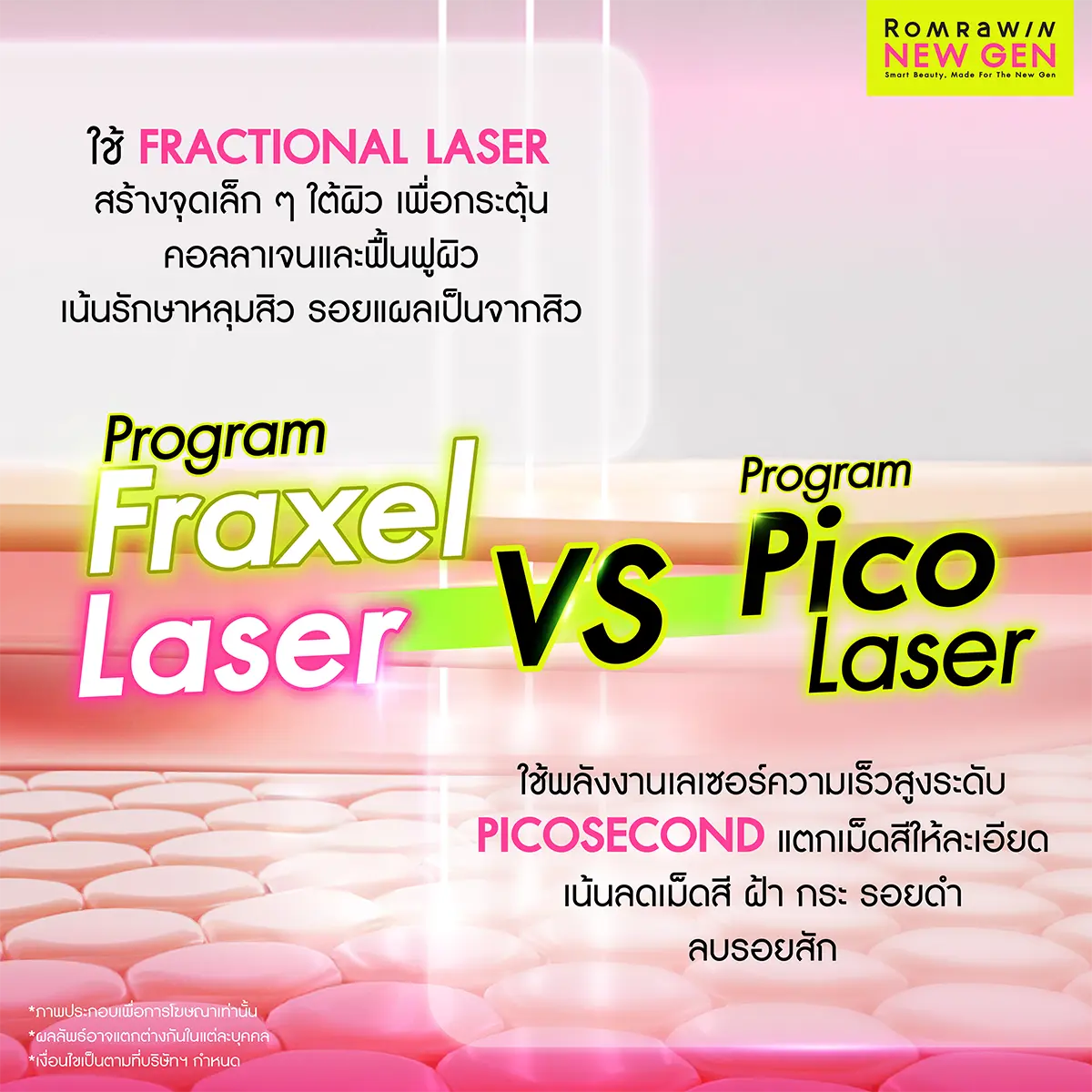 Fraxel Laser