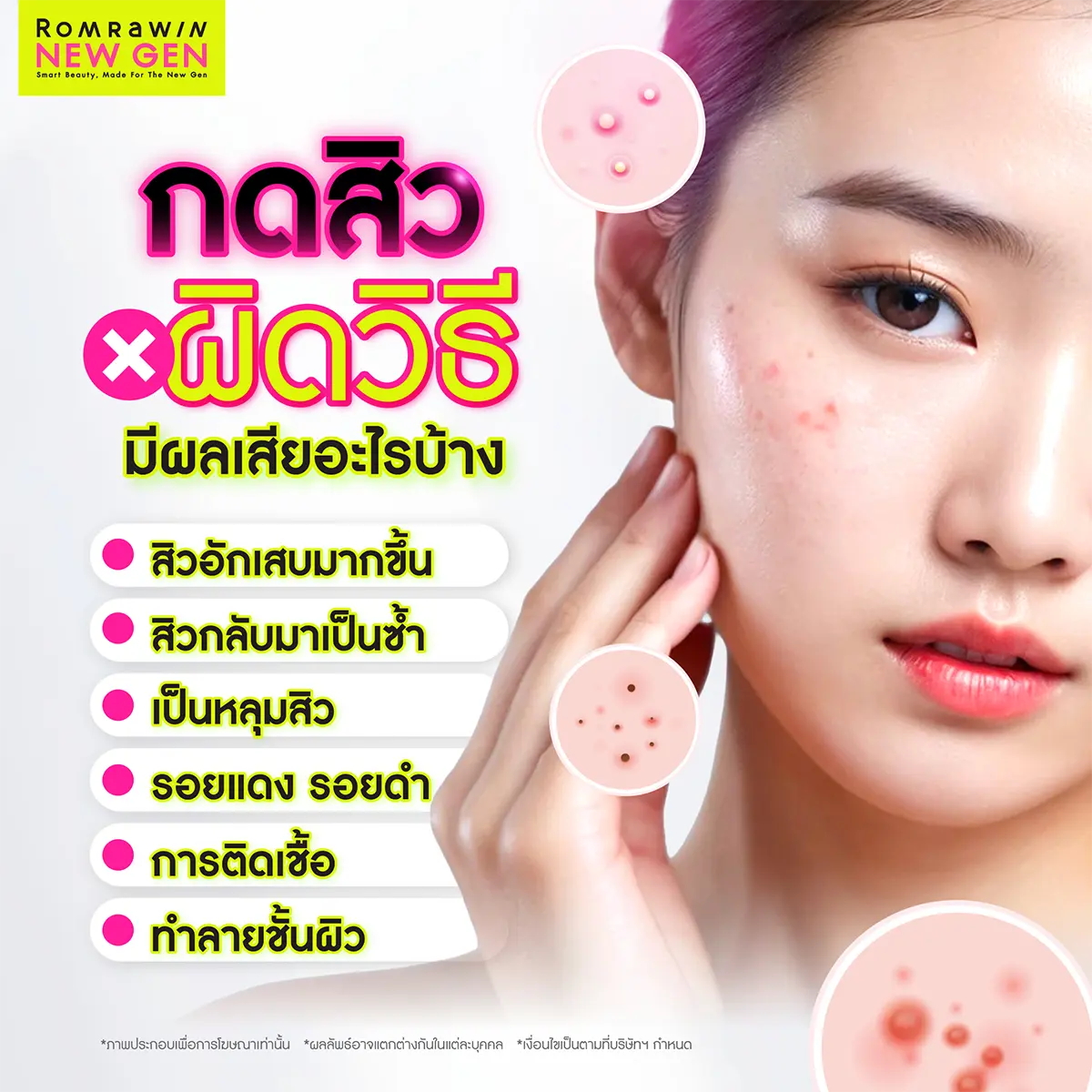 กดสิวใกล้ฉัน