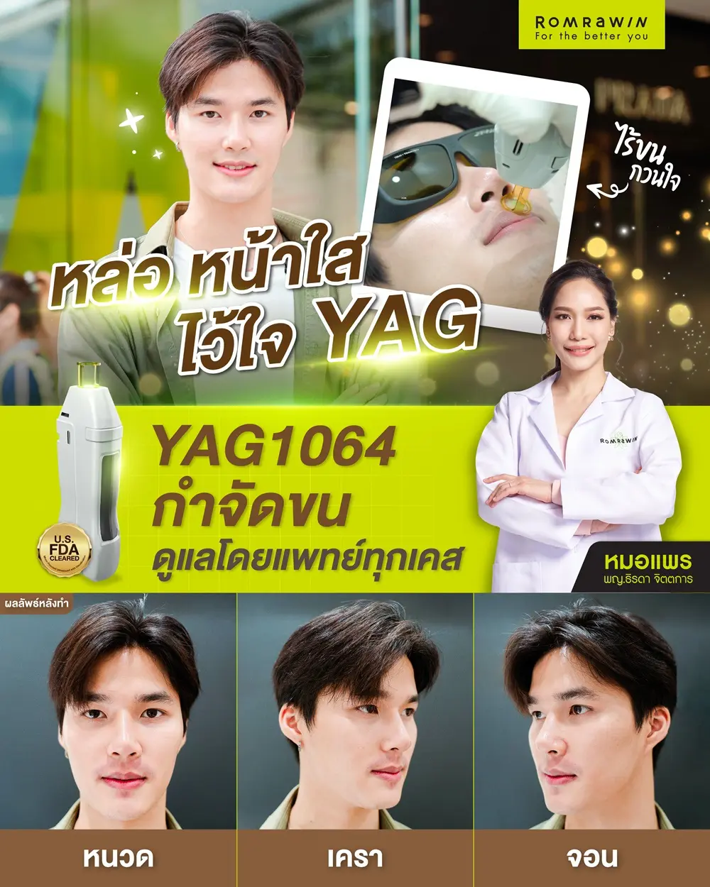 รีวิวเลเซอร์หนวด