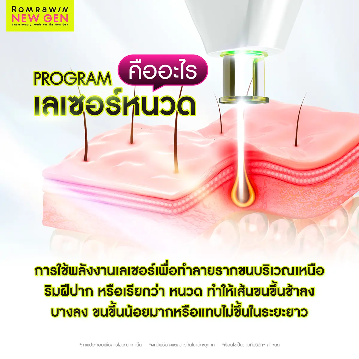 เลเซอร์หนวด
