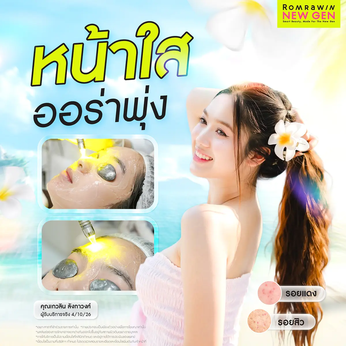 รักษาสิว