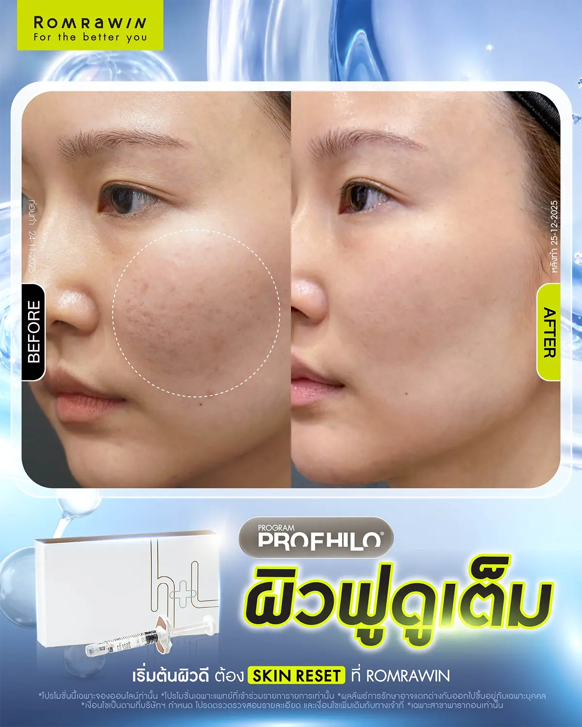 Profhilo