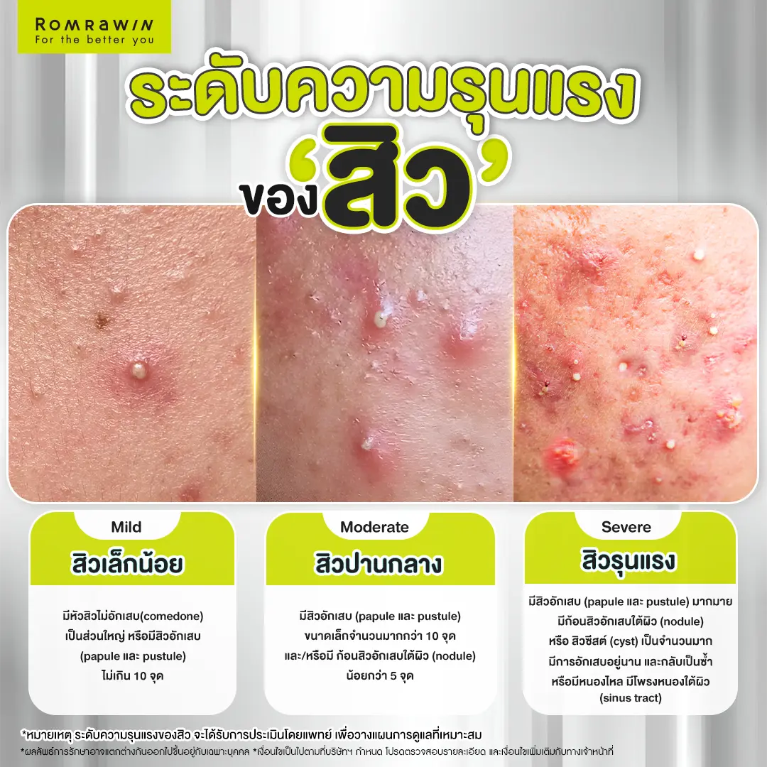 ลักษณะของสิว