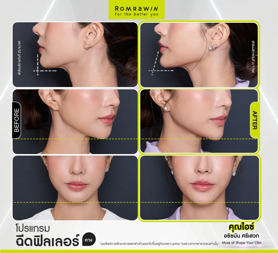 รีวิวฉีดฟิลเลอร์คาง