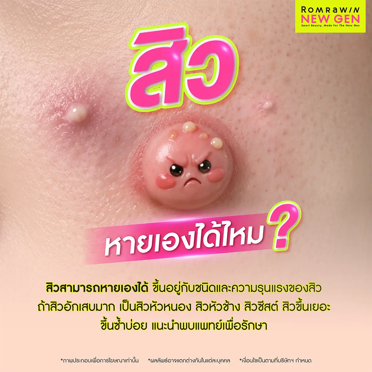 สิวไม่มีหัว นูนๆ หายเองได้ไหม เช็กโอกาสการยุบตัวของหัวสิวซีสต์และสิวหัวช้างอักเสบรุนแรงใต้ชั้นผิว