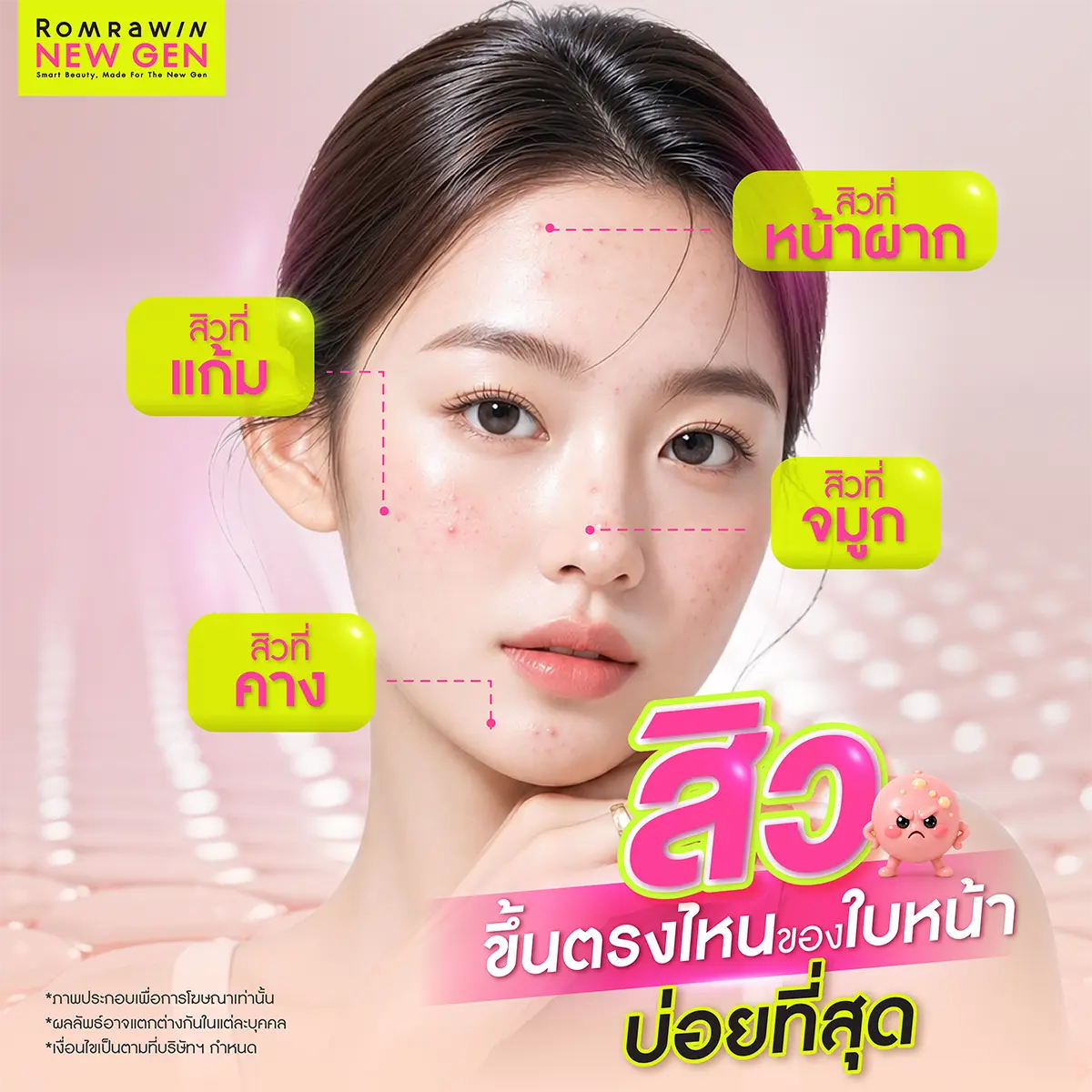สิวขึ้นตรงไหนของใบหน้าบ่อยที่สุด เช็กพิกัดตระกูลสิวอักเสบและสิ่งสกปรกอุดตันตามโซนทีโซนและยูโซนบนผิวหน้า