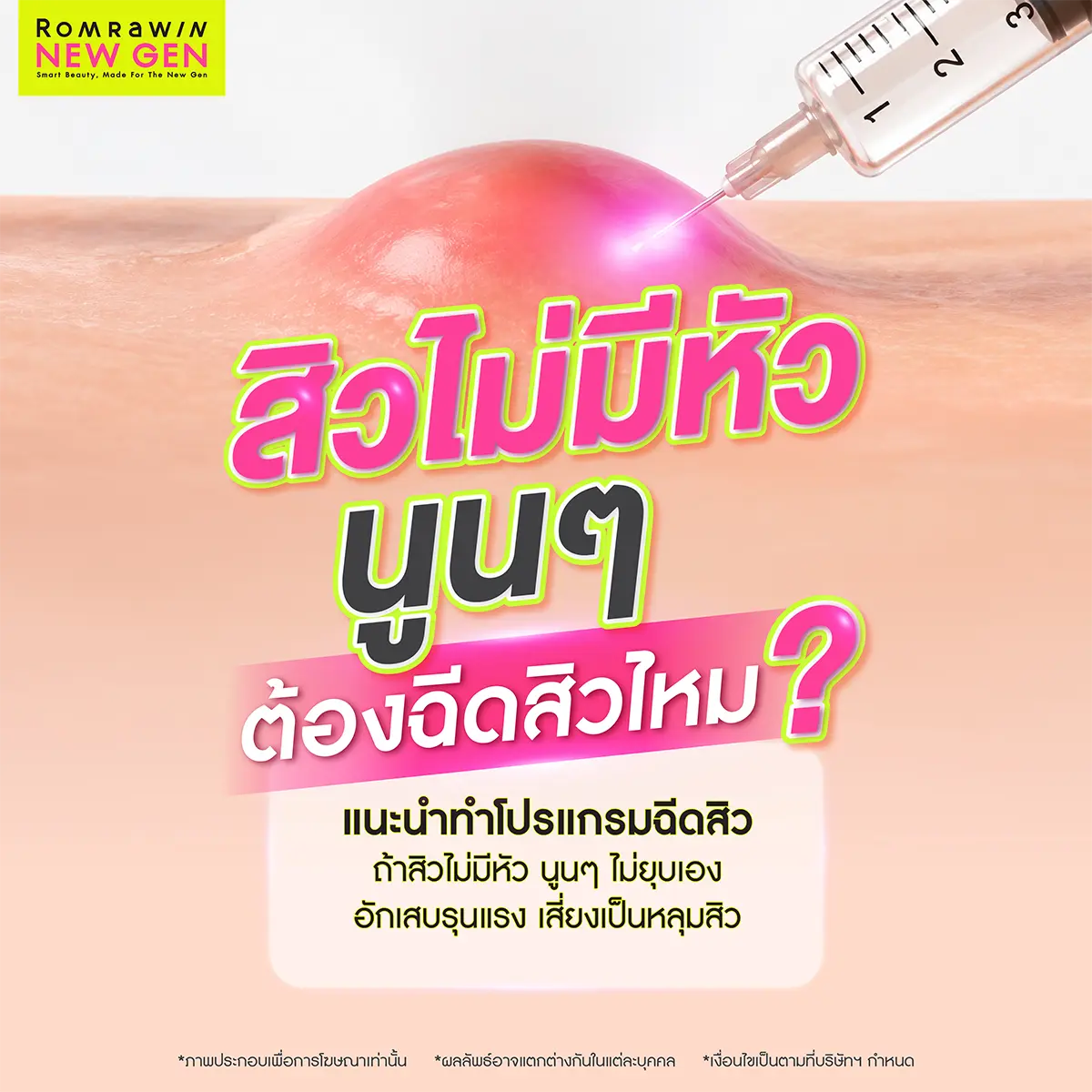 สิวไม่มีหัว นูนๆ ต้องฉีดสิวไหม ส่องทริกการลดบวมลดอักเสบจากสิวไตแข็งเม็ดใหญ่ใต้ชั้นผิวอย่างเร่งด่วน