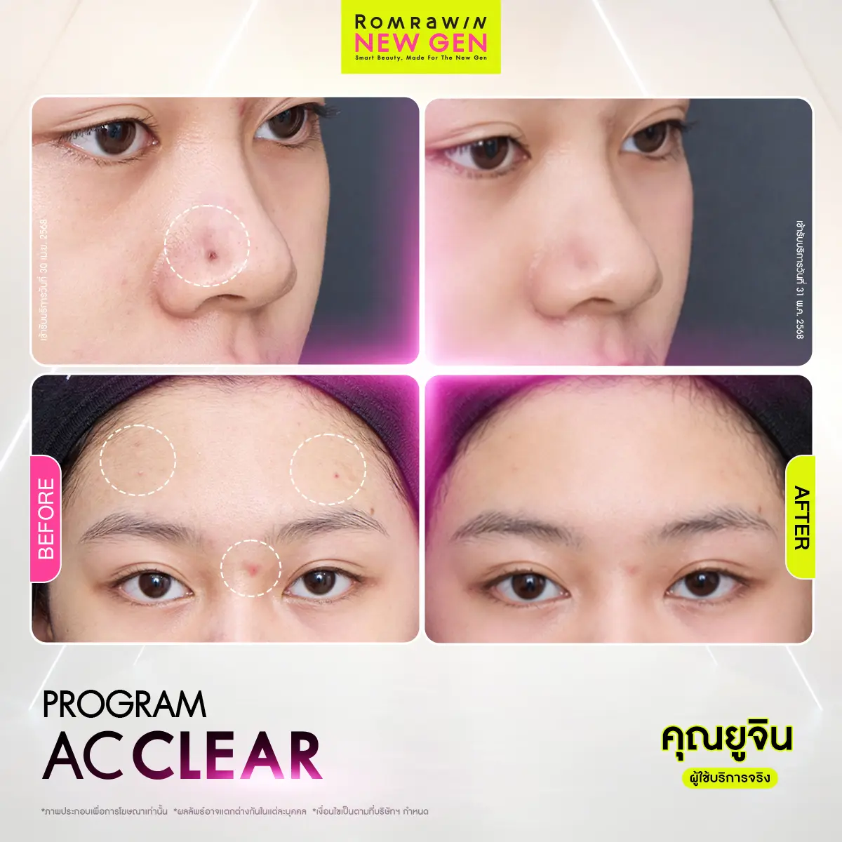 รีวิว AC Clear