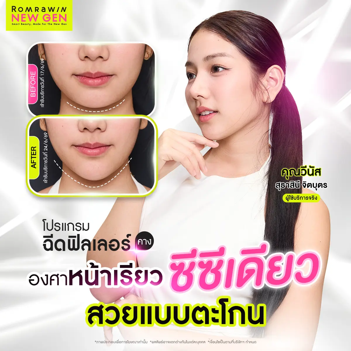 รีวิวฉีดฟิลเลอร์คาง คุณวีนัส สุธาสินี จิตบุตร