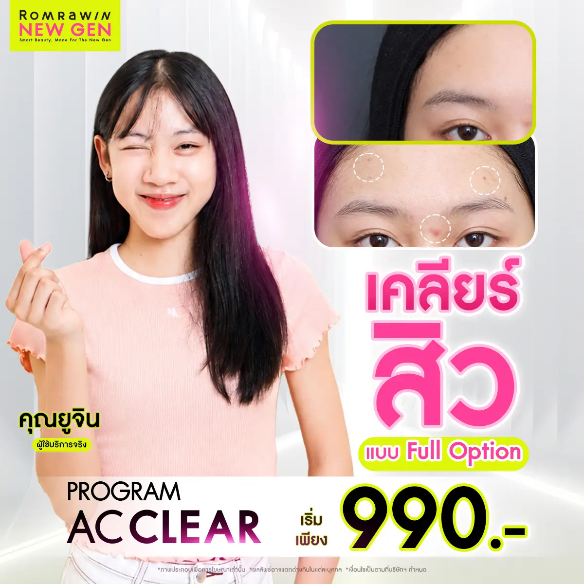 รีวิวรักษาสิว AC Clear คุณยูจิน