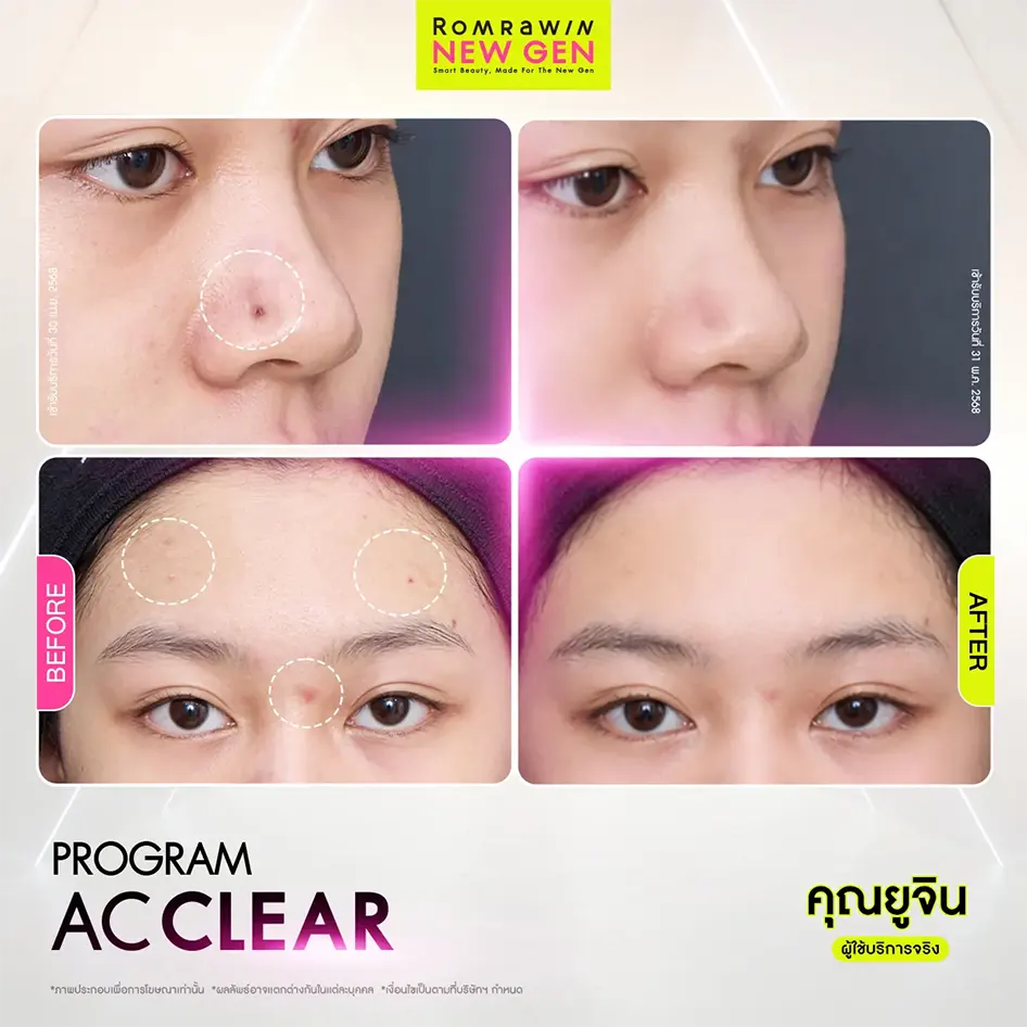 รีวิว Before After โปรแกรมรักษาสิว AC Clear รักษาผิวเป็นสิวอักเสบและลดรอยแดงสิว คุณยูจิน รมย์รวินท์คลินิก