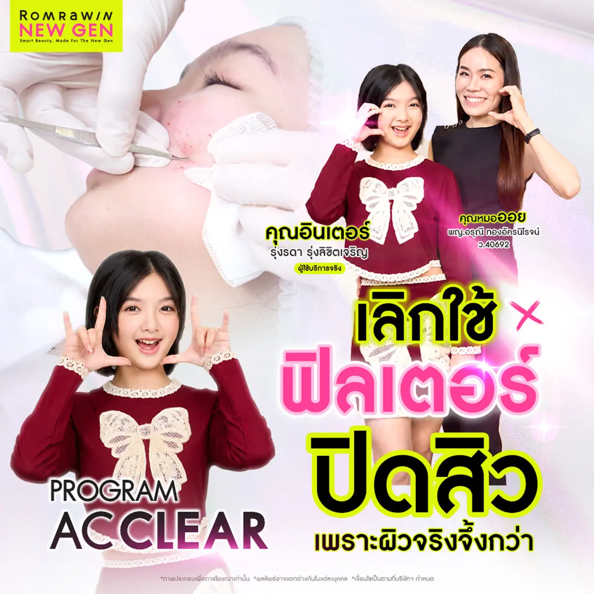 รีวิวรักษาสิว AC Clear
