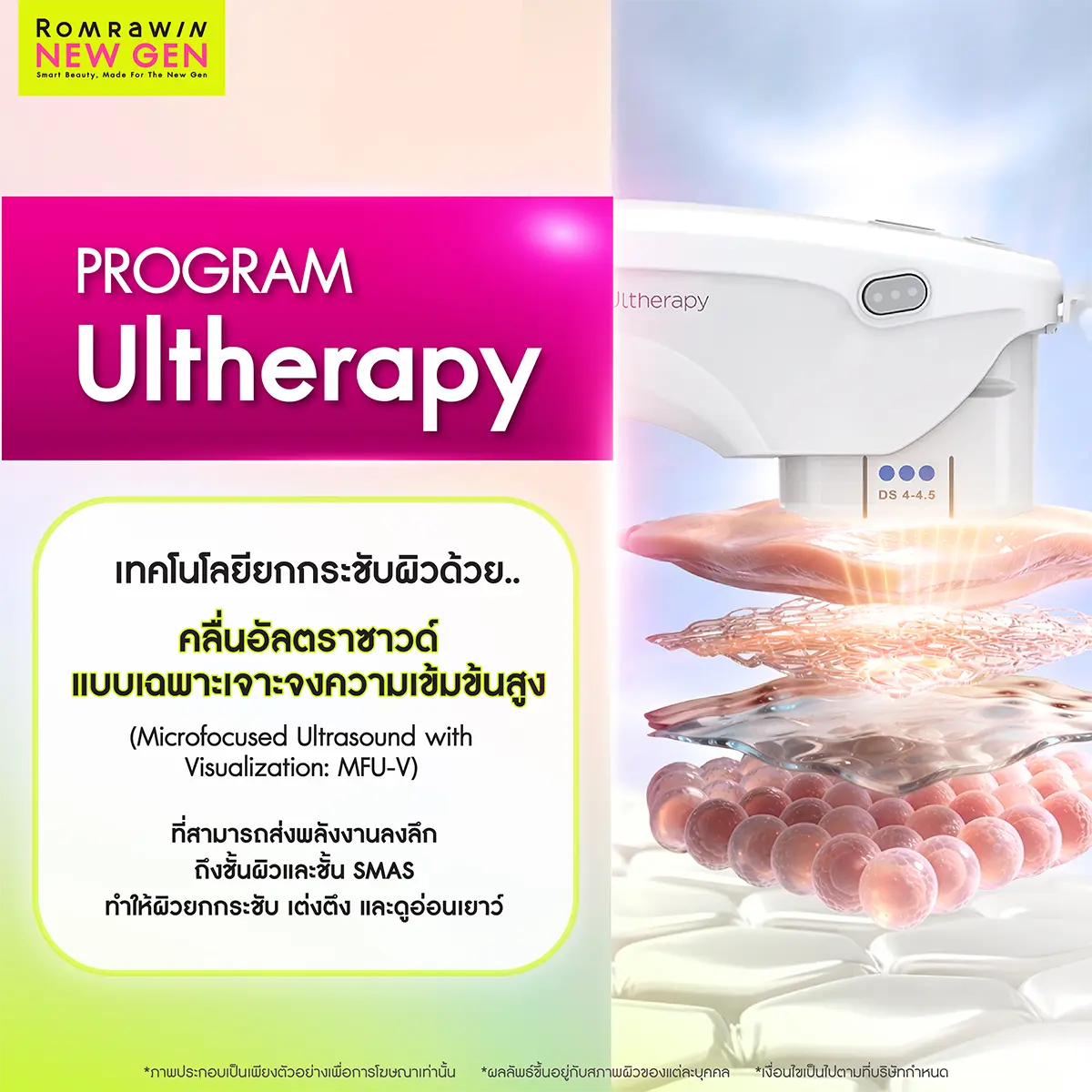 Ulthera เทคโนโลยีกระชับผิว