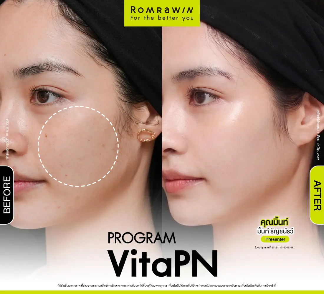 รีวิว Before After โปรแกรม VitaPN Vitaran คุณมิ้นท์ รัญชน์รวี